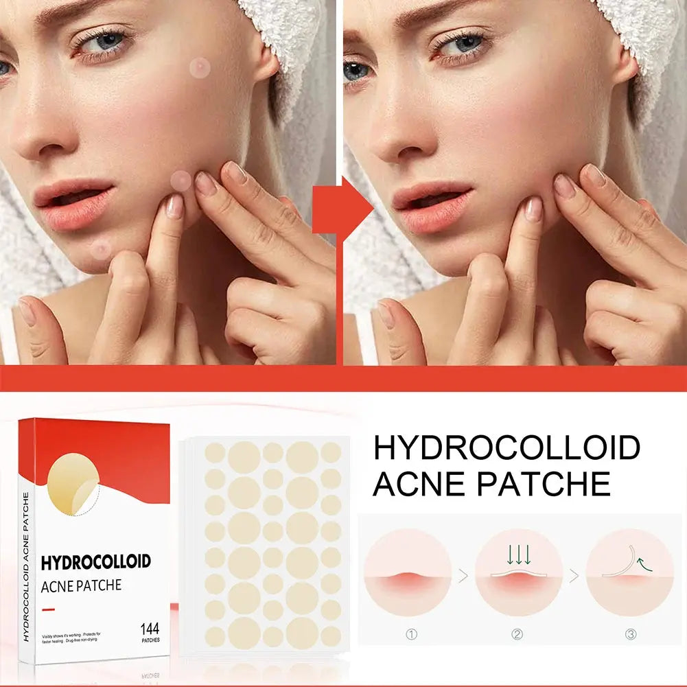 144pcs Invisible Acne Pimple Patches (2 Sizes) HypeNvibes