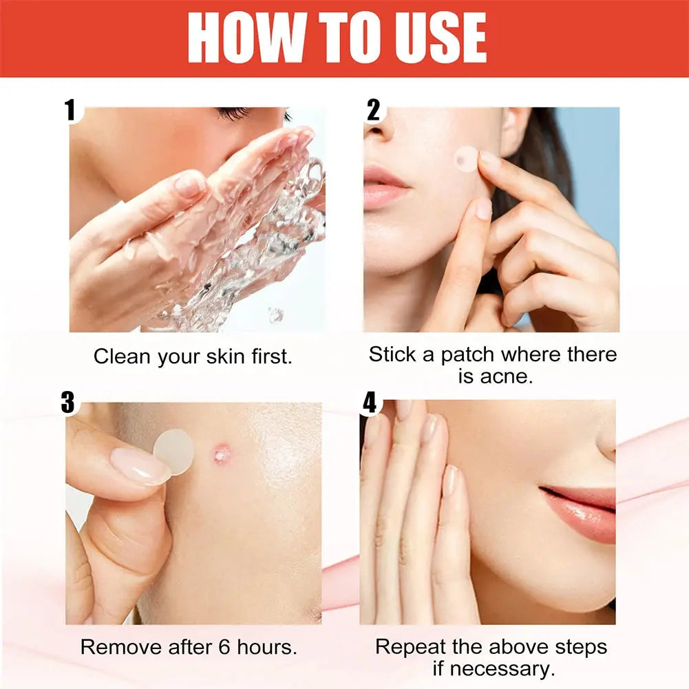 144pcs Invisible Acne Pimple Patches (2 Sizes) HypeNvibes